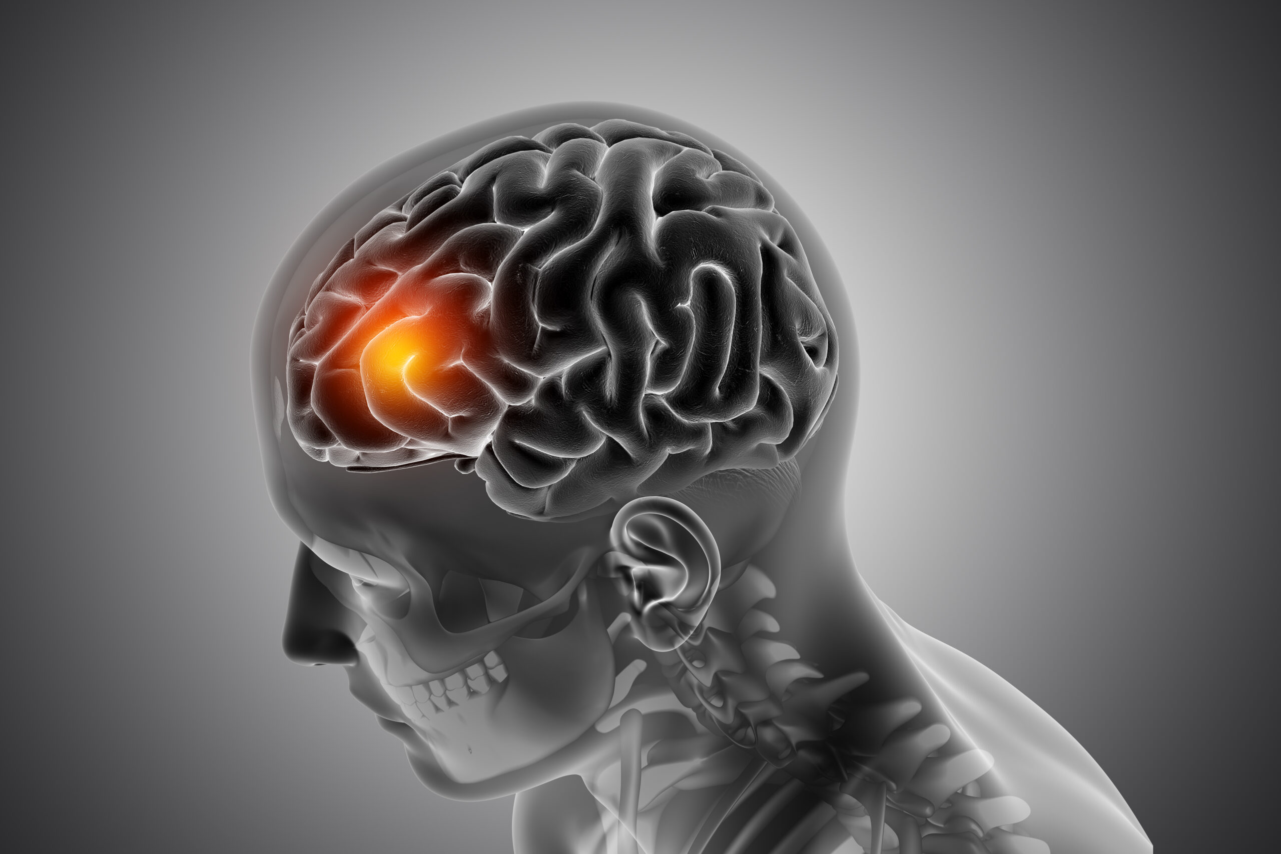 Case Study: Digital Campaign for Stroke Awareness Treatment