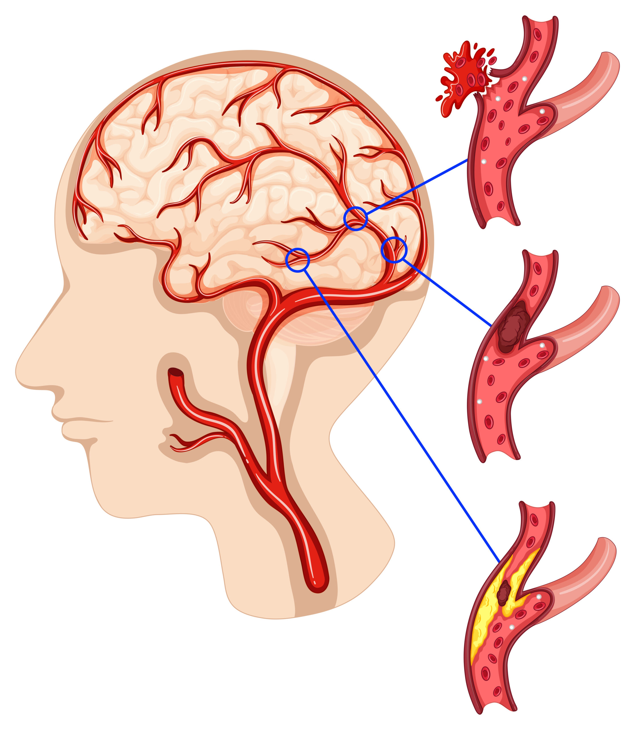 Driving Clinical Awareness for Time-Critical Stroke Care Through Omnichannel Digital Engagement